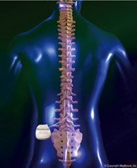 脊髄刺激療法の長所と短所