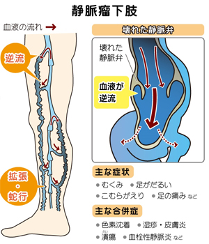 下肢静脈瘤イメージ（静脈瘤下肢）