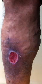 下肢静脈瘤イメージ（皮膚潰瘍）