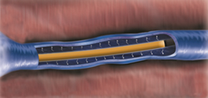 下肢静脈瘤イメージ1