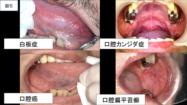 日本における口腔・咽頭がんの死亡者数⑤