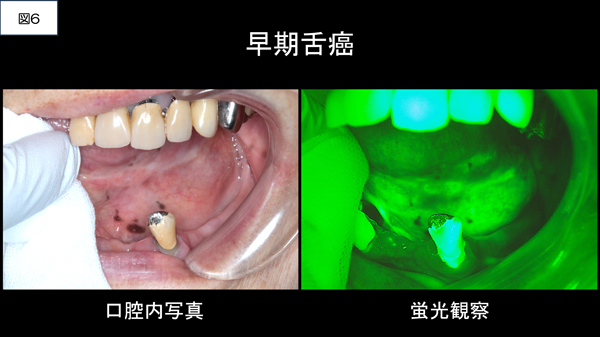 日本における口腔・咽頭がんの死亡者数⑥