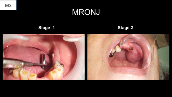 MRONJ専門外来②