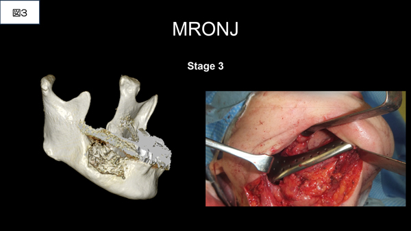 MRONJ専門外来③