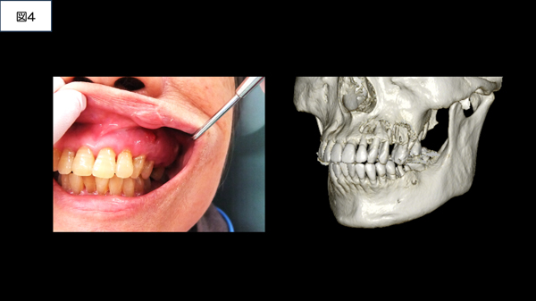 MRONJ専門外来④