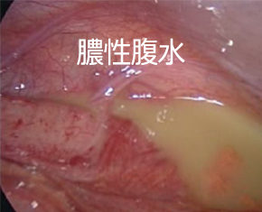 腹腔鏡手術　膿性腹水