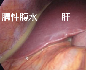 腹腔鏡手術　膿性腹水