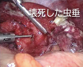 腹腔鏡手術　壊死した虫垂