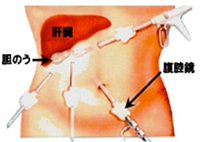 腹腔鏡手術について