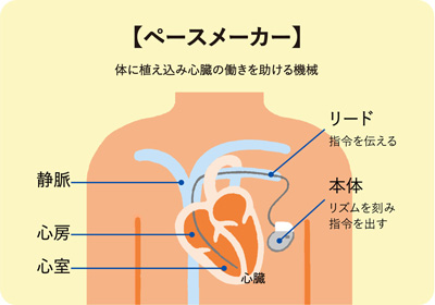 ペースメーカー